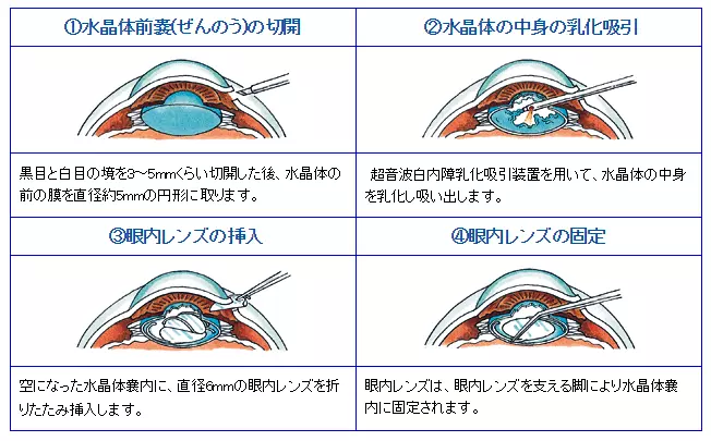白内障手術の流れ