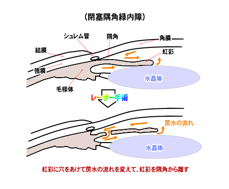 閉塞隅角緑内障