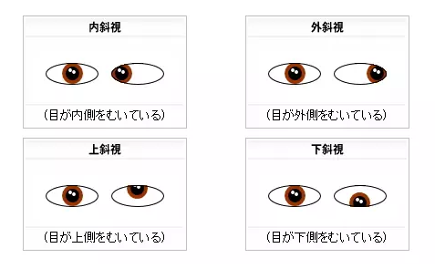 斜視