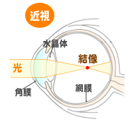 近視