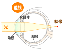 遠視